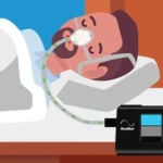 CPAP Pressure